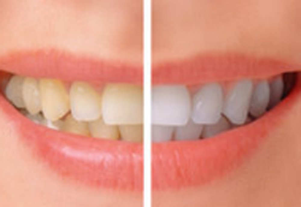 Pearl™ ALL in One Teeth Whitening System